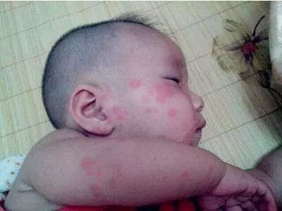 宝宝皮肤湿疹护理