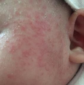 宝宝皮肤疹子护理